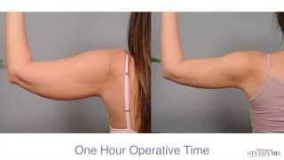 Get Firm Sculpted Arms With Smartlipo™  Dr Sterry Explains [upl. by Limaa]