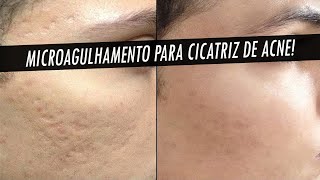 Como remover de vez cicatriz de acne do Rosto Microagulhamento com DERMAROLLER [upl. by Edythe]