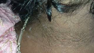 what are disease associated with acanthosis nigricans [upl. by Hteb]