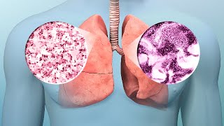 Lung Cancer Early Diagnosis Treatment [upl. by Bard]