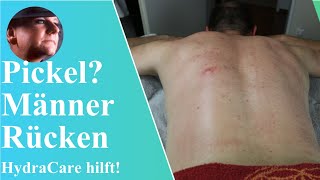 HydraCare Behandlung für Pickel und Juckreiz auf dem Männerrücken  BodyDream Kosmetikstudio [upl. by Onaicilef642]