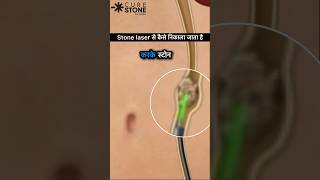 Laser Treatment of Kidney Stones  RIRS  Retrograde Intrarenal Surgery  shorts [upl. by Hteb781]