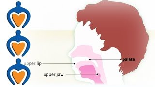 Orofacial cleft schisis  What is an orofacial cleft [upl. by Ylrrad]