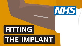 Fitting the contraceptive implant  NHS [upl. by Rissa]