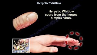 Herpetic Whitlow  Everything You Need To Know  Dr Nabil Ebraheim [upl. by Thorbert418]