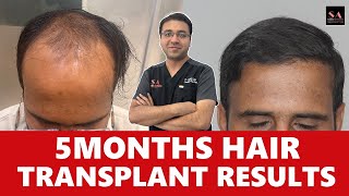 5 months hair transplant results [upl. by Groome]