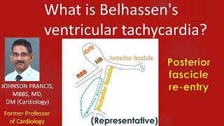 What is Belhassens ventricular tachycardia [upl. by Acirahs99]