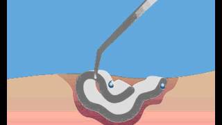 Cutimed Cavity absorption [upl. by Irrabaj]