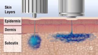 Needle vs InsuJet™ Nozzle injection [upl. by Oicapot]