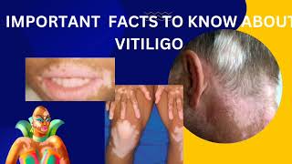 vitiligopart2diagnosis and latest treatment about opzelura creamskinhealthvitality5959 [upl. by Dorsman]