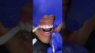 Breaking away temporary smile on revision case dentist dentistry veneers [upl. by Auqenehs]