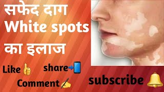 Leucoderma white spots सफेद दागफूल रोग Sure shot treatment [upl. by Yenreit647]