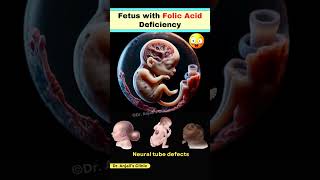 How Folic Acid Deficiency Leads to Neural Tube Defects in Pregnancy shortsviral pregnancy vitamin [upl. by Wivinia]