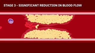 Coronary Artery Disease Animation [upl. by Sukramaj803]