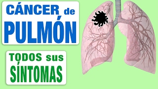 Todos Los Síntomas del Cáncer de Pulmón [upl. by Shayn878]