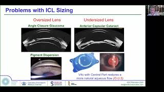 Implantable Collamer Lens ICL  from basics to advanced sizing methodology [upl. by Okomot]