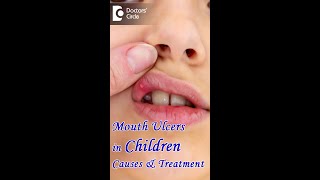 Mouth Ulcers in Children Causes amp Treatment  Dr K Saranya Doctors Circle shorts [upl. by Eisdnil]