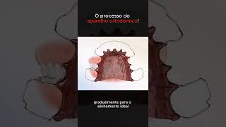 Aparelhos ortodônticos curiosidades curiosidadesmundiais fatoscuriosos mundocurioso ciencia [upl. by Tlaw]