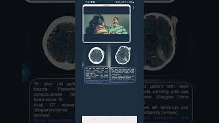 contusion vs subduralhematoma [upl. by Harris311]