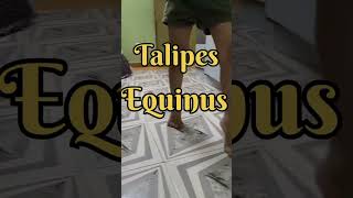 Talipes Equinus Talipes Calcaneus shorts [upl. by Zondra]