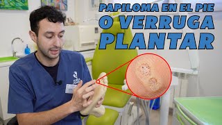 Papiloma en el pie o verruga plantar  Tipología tratamiento y prevención [upl. by Aisinut]