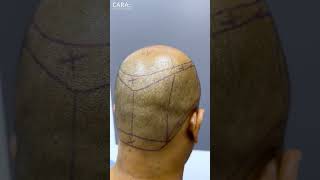 Cara Clinics REAL Hair Transplant Results That Will SHOCK You [upl. by Tomi]