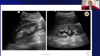 Hydronephrosis vs Normal Kidney [upl. by Row136]