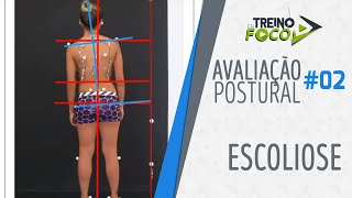 Desvio Postural de Coluna  Escoliose  Avaliação Postural 02 [upl. by Alaekim951]