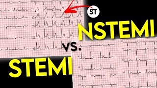 ECG interpretation  STEMI vs NSTEMI  ECG of Myocardial Infraction • Daily Cardiology [upl. by Norac]