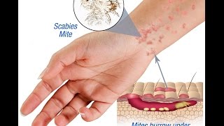 Scabies Causes Symptoms and Treatment [upl. by Elledoj]