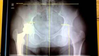 Hip Replacement Surgery and Short Leg Syndrome [upl. by Nodnarg]