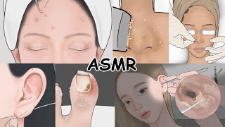 시각적 팅글 ASMR 모음집 여드름 피부관리 귀청소 내성발톱 치료  루루팡 [upl. by Lotson273]