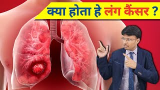 Overview of Lung Cancer Symptoms Causes and Treatment [upl. by Halimaj345]