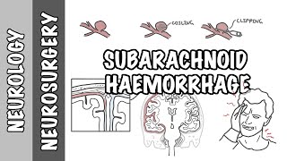 Subarachnoid Haemorrhage  pathophysiology complications and management [upl. by Hacissej]