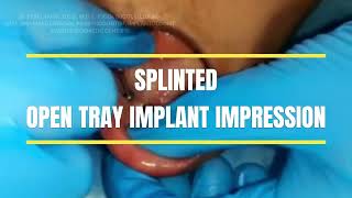 SPLINTING TECHNIQUE FOR OPEN TRAY IMPRESSION [upl. by Yendirb]