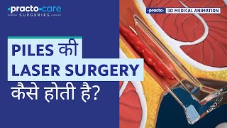 Piles Laser Surgery  Procedure Animation  Best Treatment for Piles  Practo Care Surgeries [upl. by Smeaj377]