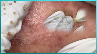 Big Cystic Acne Blackheads Extraction Blackheads amp Milia Whiteheads Removal Pimple Popping [upl. by Pleione]