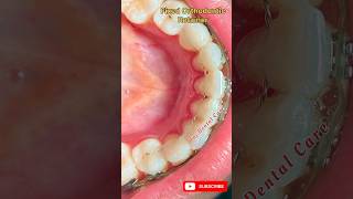 Orthodontic Fixed Retainer orthodonticstreatmentshorts [upl. by Neirad944]