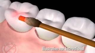 Laser Gum Treatment Laser Assisted New Attachment Procedure LANAP [upl. by Mosra]