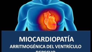 Miocardiopatía arritmogénica [upl. by Icart894]