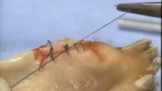 Introduction to Periodontal Surgery Techniques Initial Incisions and Suturing [upl. by Trotter677]