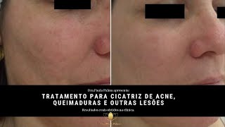 Tratamento com microagulhamento para cicatriz de acne queimaduras e lesões veja os resultados [upl. by Kursh]