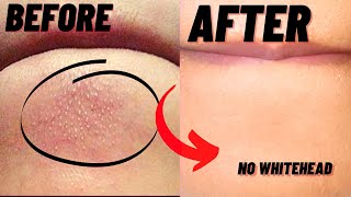 How To Remove Whiteheads And Blackheads From Chin At Home [upl. by Priebe187]