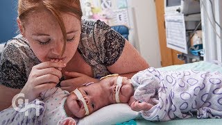 Conjoined Twins Abby and Erin Delaney A Year in the Life [upl. by Darra]