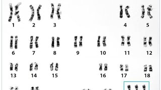 KARYOTYPE amp SYMPTOMS OF SUPER FEMALE SYNDROME [upl. by Shurlocke495]