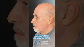 Blefaroplastia y Pexia de Cejas  Cirujano Polistina shorts short [upl. by Obala214]