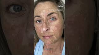 Melasma Can Be Cured With Hydroquinone Dermatologist Explains [upl. by Rovaert]