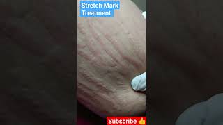 Stretch Mark Treatment lasertreatment viral shortsvideo [upl. by Ikkaj]