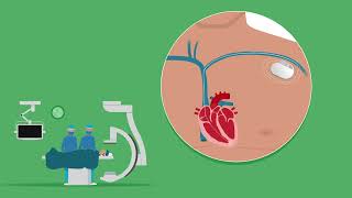 Hoe gaat het plaatsen van een pacemaker of ICD [upl. by Urien]