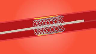 Stent procedure [upl. by Johnath303]